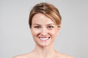 woman smiling before and after botox